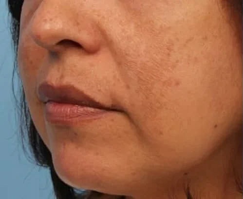 Before and After Lutronic Hollywood Spectra