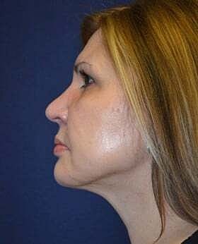 Neck Lift Before & After
