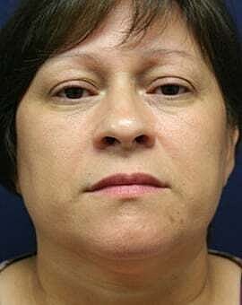 Neck Lift Before & After