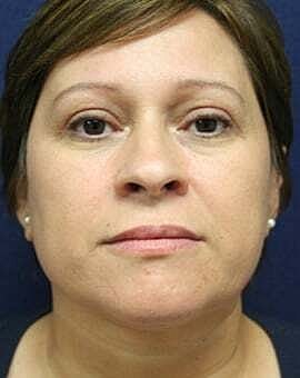 Neck Lift Before & After