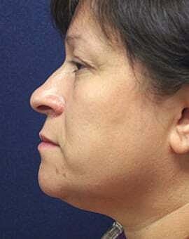 Neck Lift Before & After