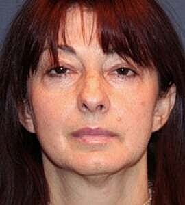 Neck Lift Before & After