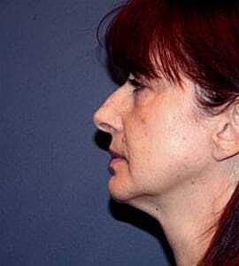Neck Lift Before & After