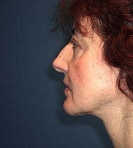 Neck Lift Before & After