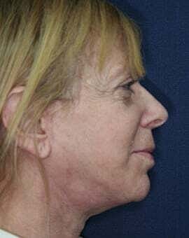 Neck Lift Before & After
