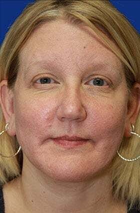 Neck Lift Before & After