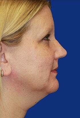 Neck Lift Before & After