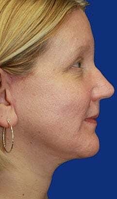 Neck Lift Before & After