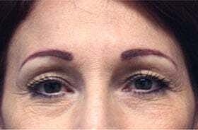 Blepharoplasty Before & After
