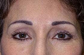 Blepharoplasty Before & After