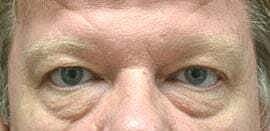 Blepharoplasty Before & After