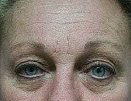 Blepharoplasty Before & After
