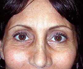 Blepharoplasty Before & After