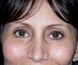 Blepharoplasty Before & After