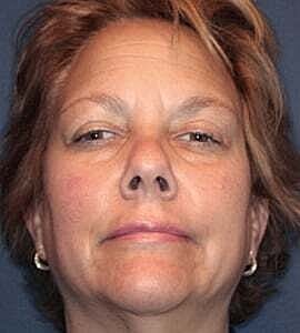 Blepharoplasty Before & After