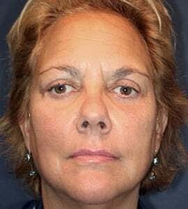 Blepharoplasty Before & After