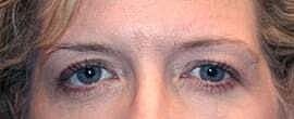 Blepharoplasty Before & After