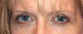 Blepharoplasty Before & After