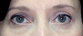 Blepharoplasty Before & After