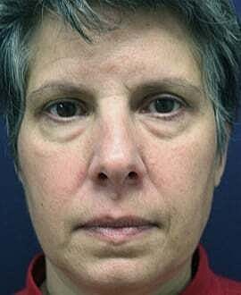 Blepharoplasty Before & After
