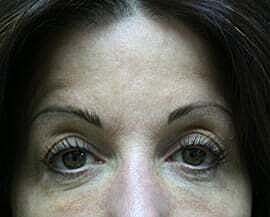 Blepharoplasty Before & After
