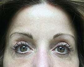 Blepharoplasty Before & After