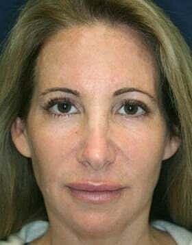 Blepharoplasty Before & After
