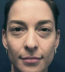 Blepharoplasty Before & After