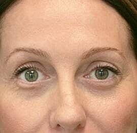 Blepharoplasty Before & After