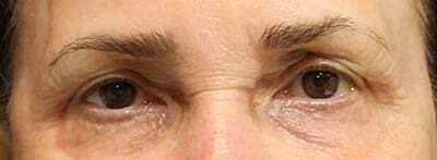 Blepharoplasty Before & After