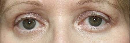 Blepharoplasty Before & After