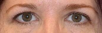 Blepharoplasty Before & After