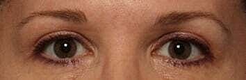Blepharoplasty Before & After