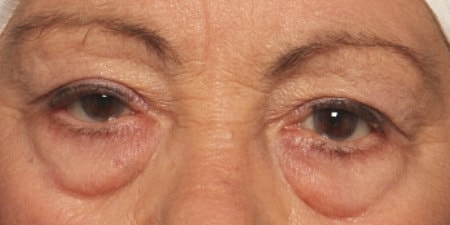 Blepharoplasty Before & After