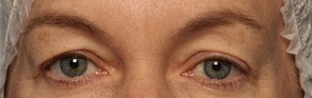 Blepharoplasty Before & After