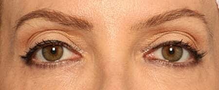 Blepharoplasty Before & After