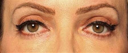 Blepharoplasty Before & After