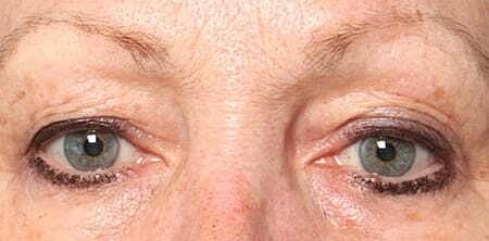 Blepharoplasty Before & After