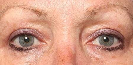 Blepharoplasty Before & After