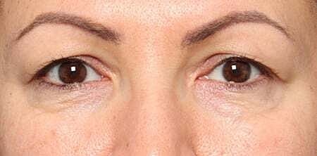 Blepharoplasty Before & After