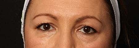 Blepharoplasty Before & After