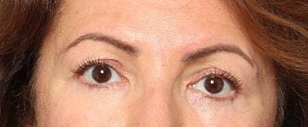 Blepharoplasty Before & After