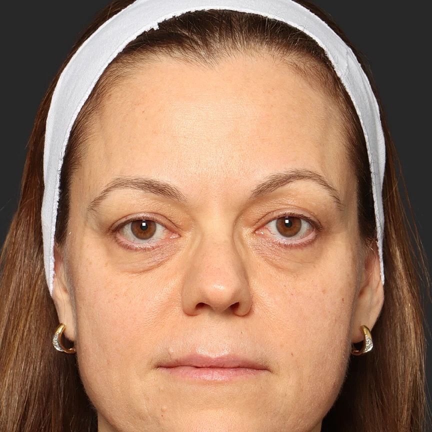 Blepharoplasty Before & After
