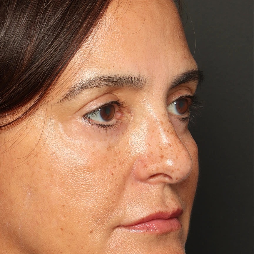 Blepharoplasty Before & After