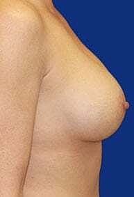 Breast Augmentation With Lift Before & After