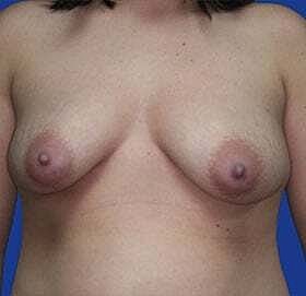 Breast Augmentation With Lift Before & After