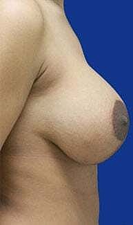 Breast Augmentation With Lift Before & After