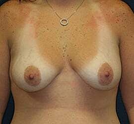 Breast Augmentation With Lift Before & After