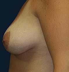 Breast Augmentation With Lift Before & After