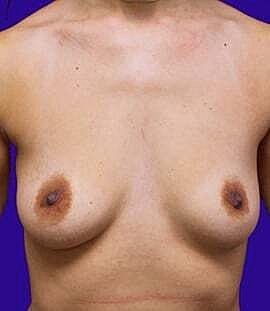 Breast Augmentation With Lift Before & After